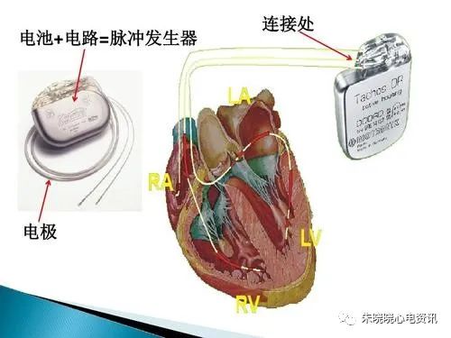 最新起搏器，最新起搏器技術(shù)介紹